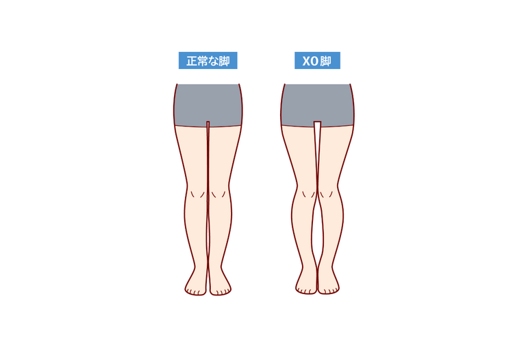 【XO脚改善】アライメントを整えてスッキリした脚に！｜太田市でジムならリラクゼーションから運動指導までRINK